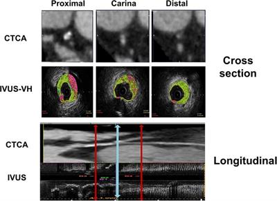 Multislice computerized tomography coronary angiography can be a comparable tool to intravascular ultrasound in evaluating “true” coronary artery bifurcations